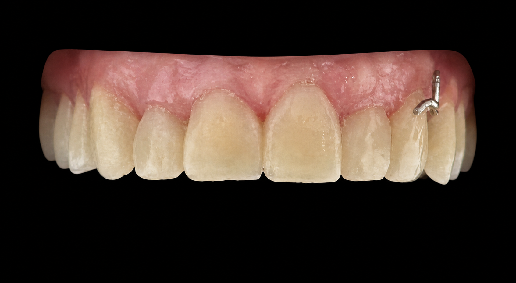 Ergebnis nach der zweiten Injection-Moulding-Behandlung