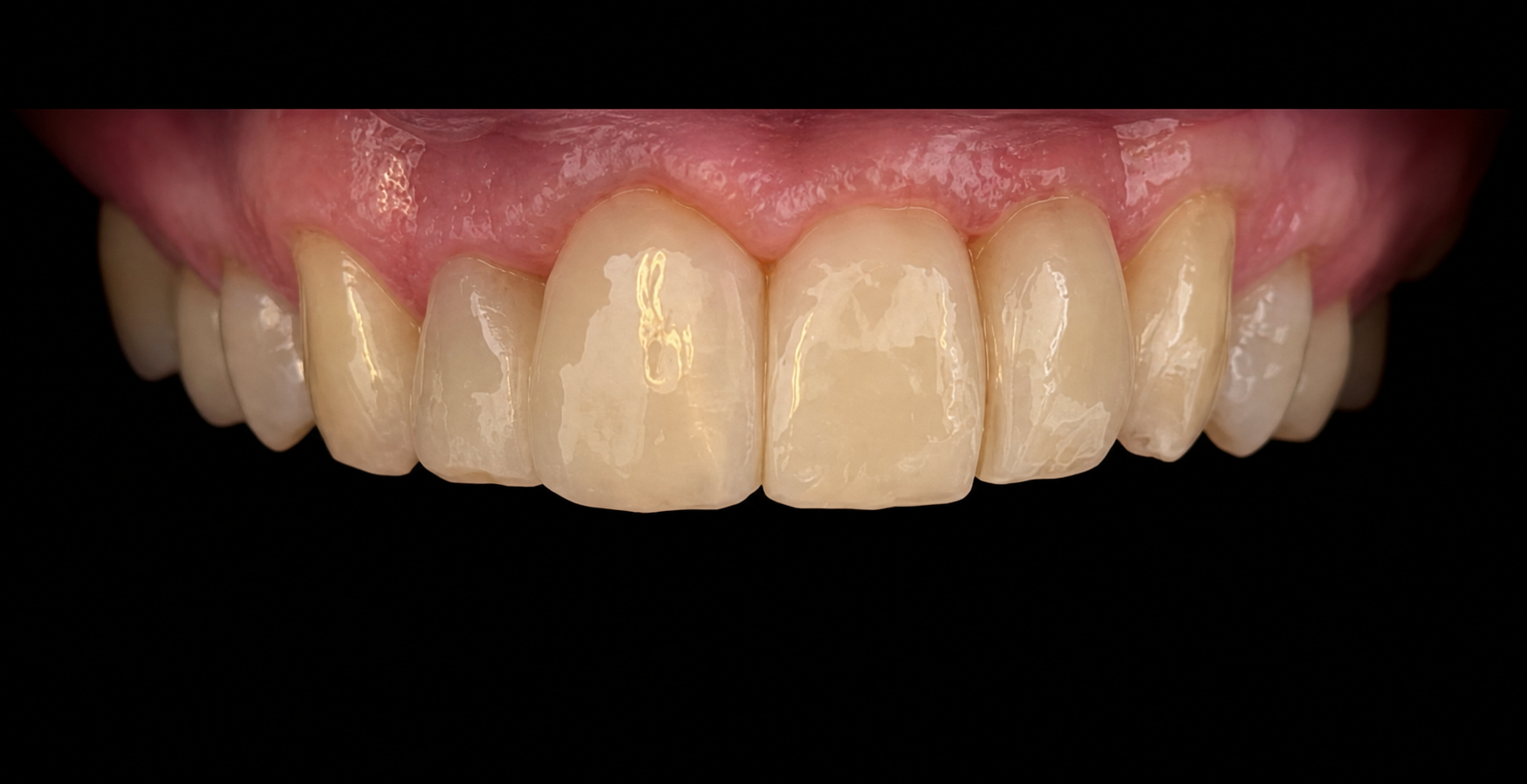 Ergebnis nach der Injection-Moulding-Behandlung