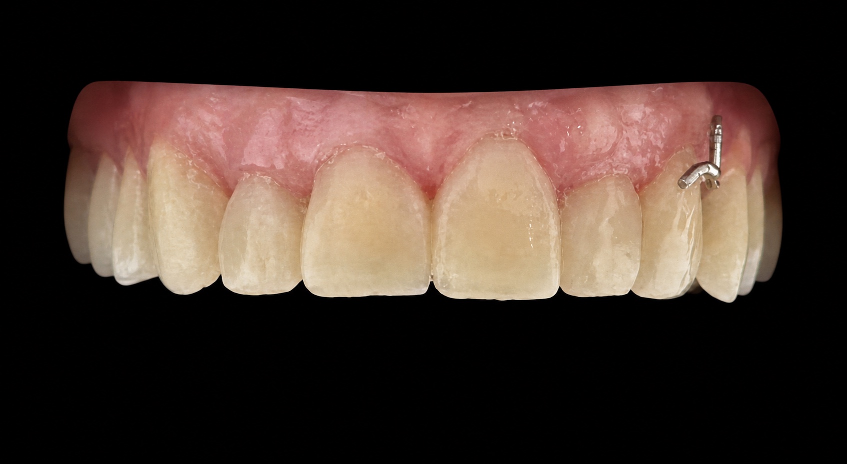 Ergebnis nach der zweiten Injection-Moulding-Behandlung