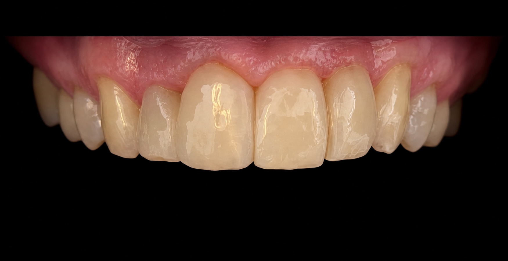 Ergebnis nach der Injection-Moulding-Behandlung